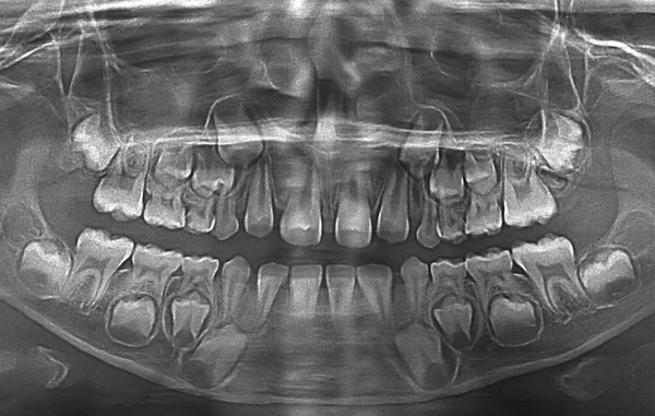 X ray of child teeth — Stock Photo, Image