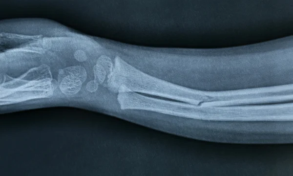 Imagem de raio-X de uma mão quebrada — Fotografia de Stock