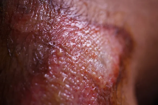 skin zoster treatment herpes from Stock Photo zoster virus. infection â herpes