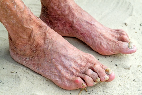Nemocné nohy staré ženy — Stock fotografie