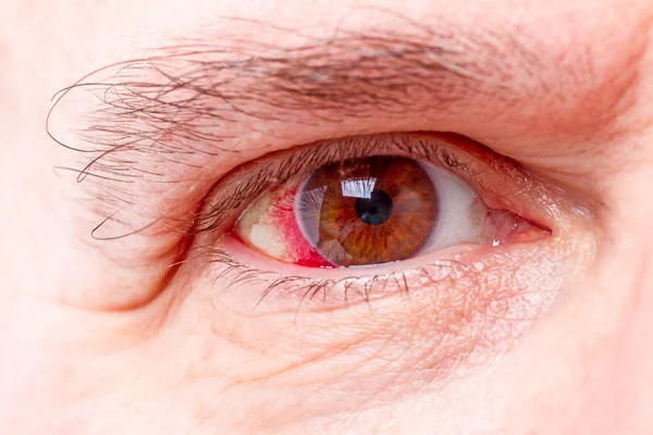 Rotes menschliches Auge — Stockfoto