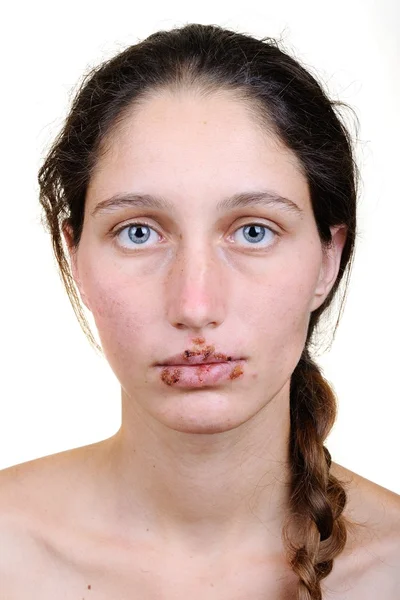 Žena s herpes virus — Stock fotografie
