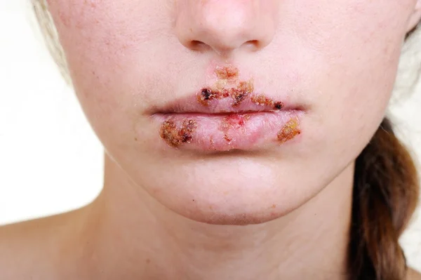 Primer plano de los labios afectados por el herpes — Foto de Stock