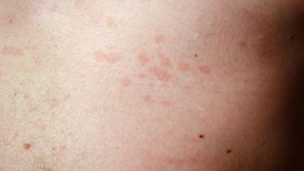 Krankheit Auf Der Haut Dermatitis Flechten Auf Dem Körper Eines — Stockvideo