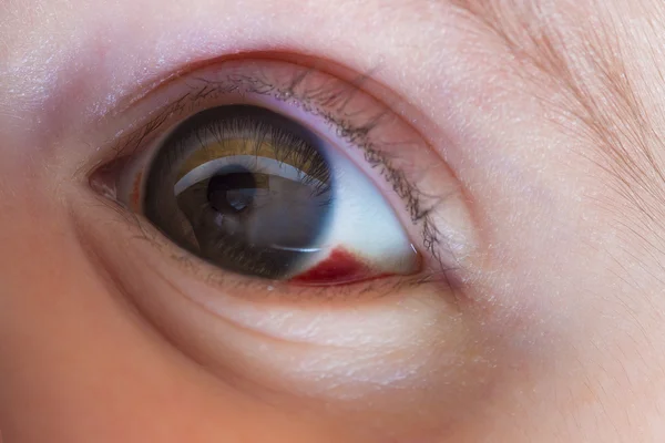 Red bloddshot eyes — Stock Photo, Image