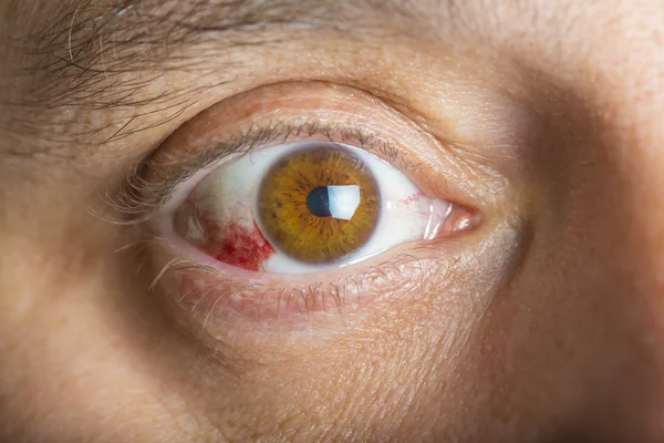 Red bloddshot eyes — Stock Photo, Image