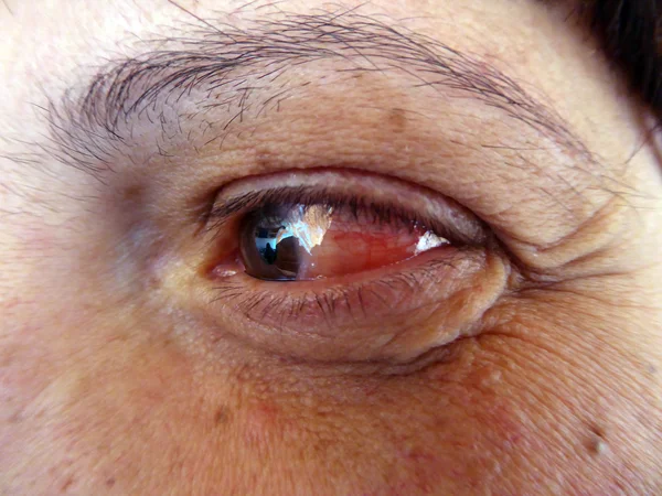Lékařská zdravotní péče krev kapilární lidské oko — Stock fotografie