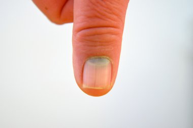 Injured  male finger clipart