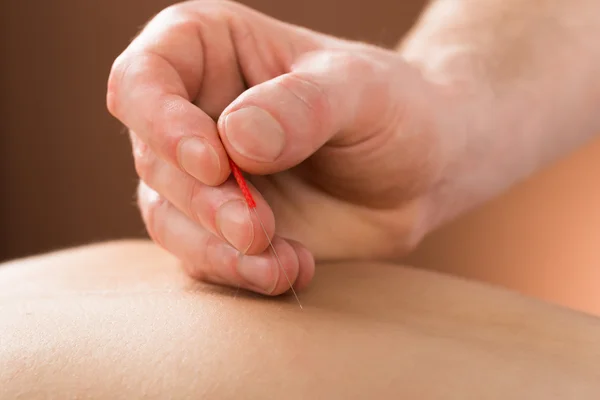 Akupunktúrás kezelésben részesülő személy — Stock Fotó