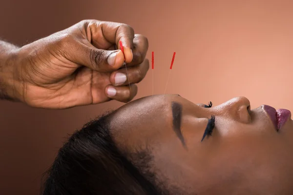 Mulher recebendo tratamento de acupuntura — Fotografia de Stock