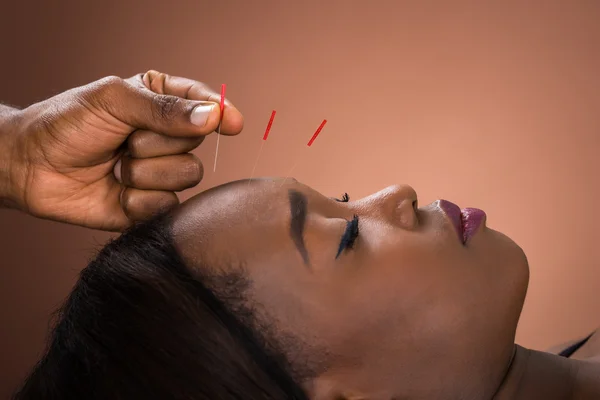 Jeune femme recevant un traitement d'acupuncture — Photo