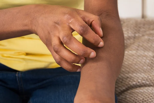 Frau leidet unter Juckreiz — Stockfoto