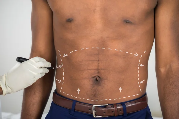 Hand Drawing Correction Lines On Abdomen — Stock Photo, Image