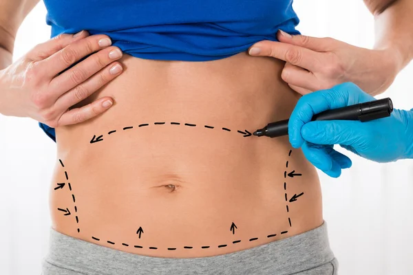 Drawing Correction Lines On Stomach — Stock Photo, Image