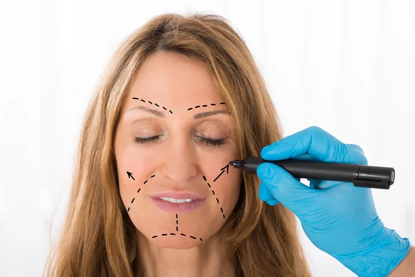 Chirurg tekening correctieregels op vrouw gezicht — Stockfoto