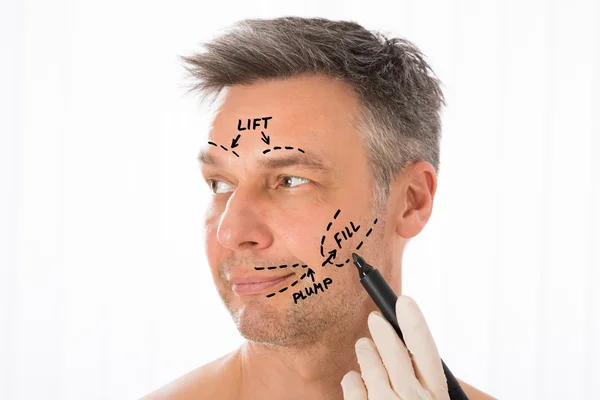 Хирург рисует коррекционные линии на человеческом лице — стоковое фото