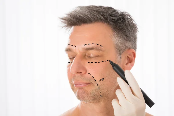 Chirurgien dessinant des lignes de correction sur le visage de l'homme — Photo