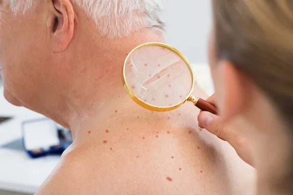 Läkare kontrollera huden hos Patient med förstoringsglas — Stockfoto