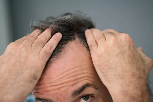Man Memeriksa Kehilangan Rambut Nya Dan Dandruff — Stok Foto