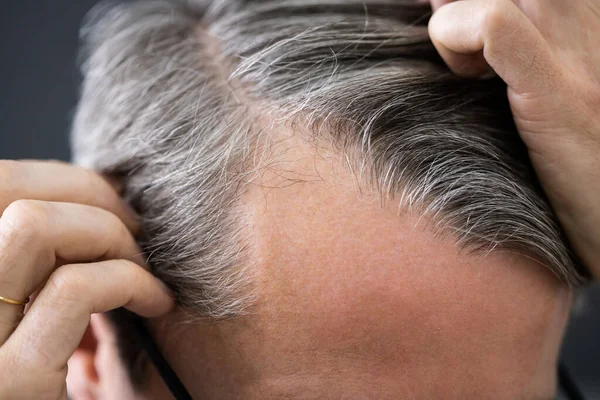 Balding Man Losing Hair Checking Scalp Hair Loss — Stock Photo, Image