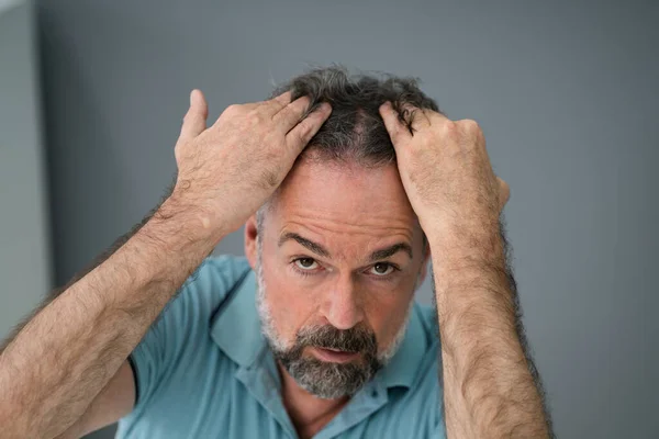 Muž Kontrolující Jeho Vypadávání Vlasů Lupy — Stock fotografie