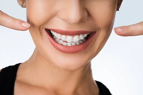 Vrouwelijke Mond Met Metalen Witte Tanden Beugels Beugels — Stockfoto