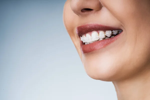 Weiblicher Mund Mit Weißen Zahnspangen Oder Brackets Aus Metall — Stockfoto