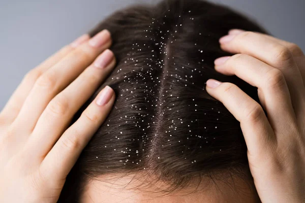 Picazón Cuero Cabelludo Cabello Problema Caspa — Foto de Stock