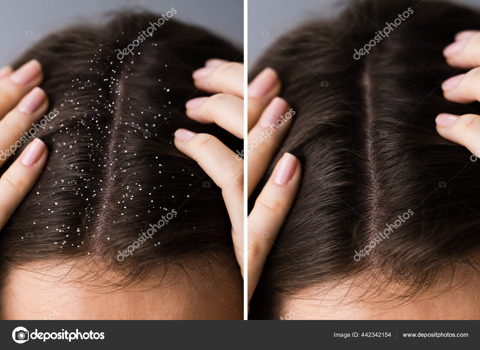 Itchy Head Scalp Dandruff Problem Stock Photo by ©AndreyPopov 442342154