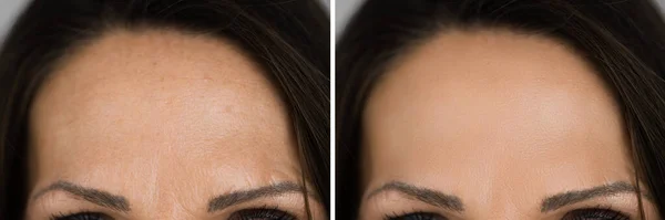 Anti Rejuvenation Forehead Wrinkles Lift Before And After