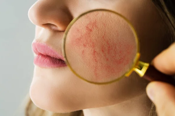 Rosacea Face Skin Problem Aesthetic Treatment — Stock Photo, Image