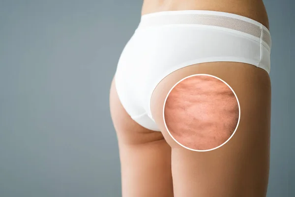 Cellulite Inflammation On Legs Closeup. Medical Liposuction