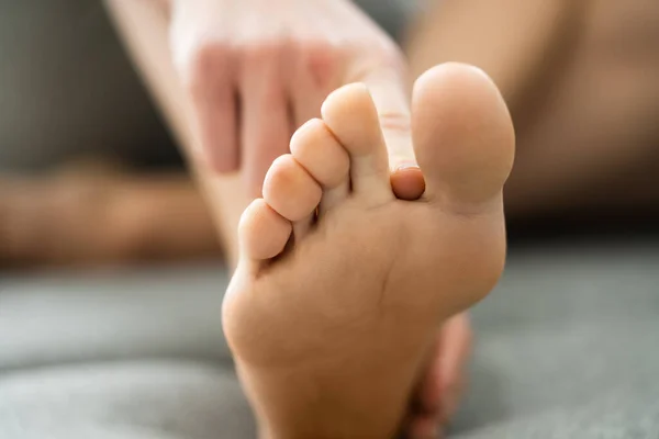 Athlete Foot Fungal Infection Itching Toes — Stock Photo, Image
