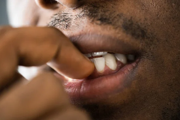 Neurotisk Nagelbitning Händer Och Mun Närbild — Stockfoto