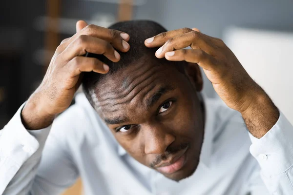 Jovens Africano Homens Perda Cabelo Assistindo Queda Cabelo — Fotografia de Stock