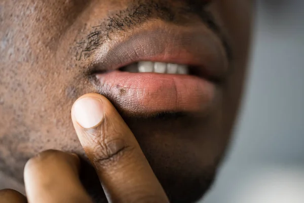 Africano Americano Boca Lábio Pele Herpes Tratamento — Fotografia de Stock