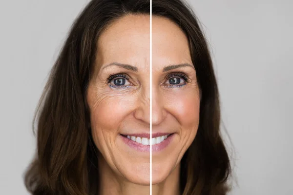 Rejuvenation Wrinkles Lift — Stock Photo, Image