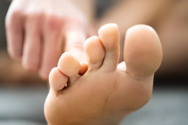 运动脚部真菌感染 脚趾间的瘙痒 — 图库照片