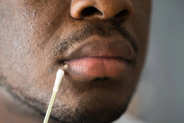 Traitement Des Lèvres Herpétiques Douloureuses Sur Visage Masculin — Photo