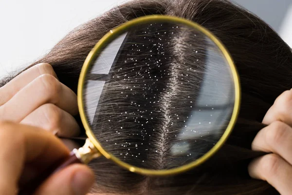 Trattamento Del Problema Del Cuoio Capelluto Forfora Prurito Dei Capelli — Foto Stock