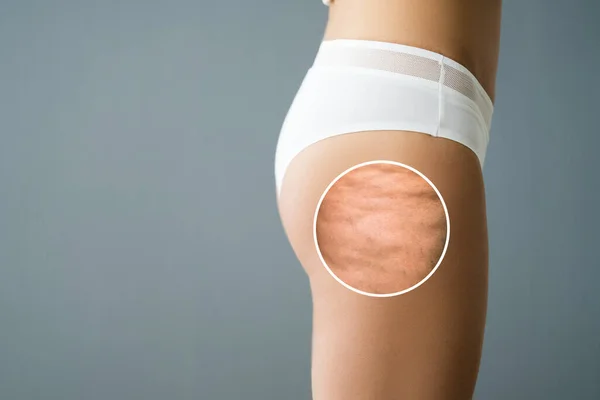 Infiammazione Della Cellulite Sulle Gambe Primo Piano Liposuzione Medica — Foto Stock