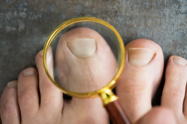 Ingrown Nail Problem Infected Red Feet Toenail — Stock Photo, Image