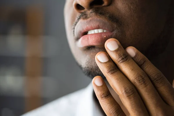 Africké Americké Ústa Rty Kůže Herpes Léčba — Stock fotografie