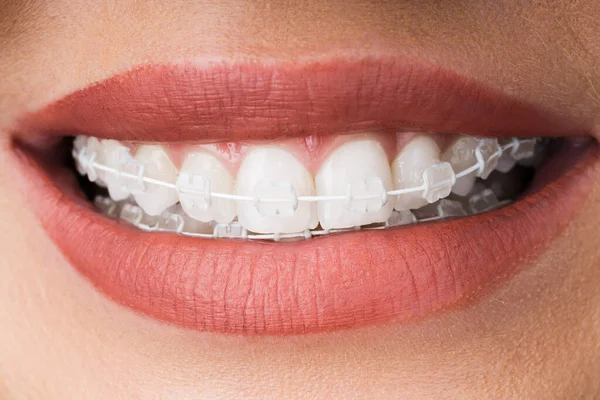 Boca Feminina Com Metal Branco Dental Braces Suportes — Fotografia de Stock