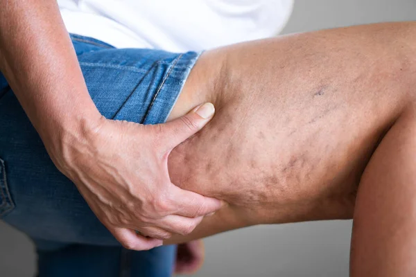 Vet Vrouw Lichaam Met Huid Cellulitis Voor Liposuctie — Stockfoto