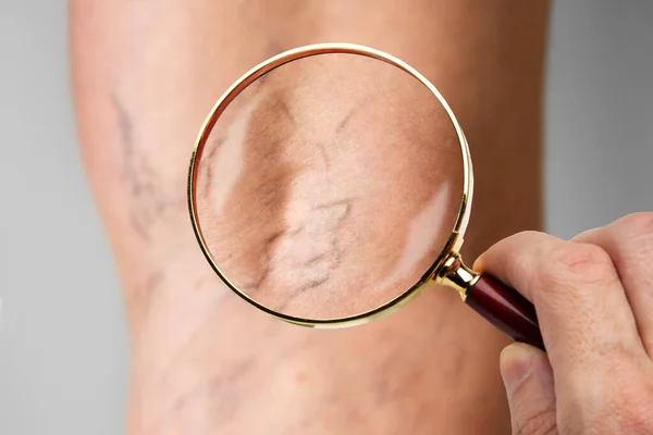 Leg Vein Varicose Disease And Pain. Blood Pressure Problem