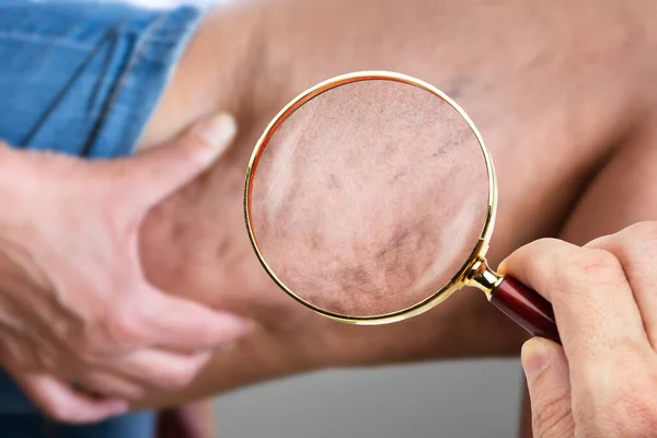 Corpo Mulher Gorda Com Celulite Pele Antes Lipoaspiração — Fotografia de Stock