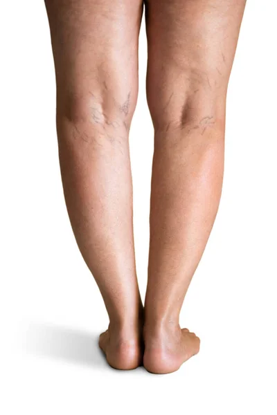 Žilní Křečová Nemoc Bolest Nohou Problém Krevním Tlakem — Stock fotografie