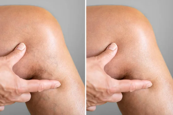 Laser Tedavisinden Önce Sonra Bacak Damarı Varisleri — Stok fotoğraf