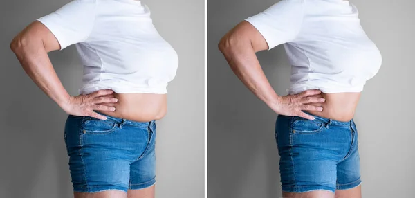 体重减轻前后脂肪吸入手术 — 图库照片